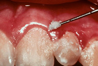 Зубной налет - угроза для мозга