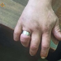 Олександрівка: рятувальники допомогли зняти каблучку з пальця чоловіка